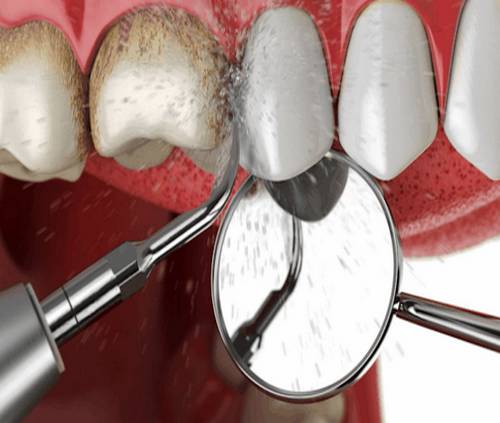  جرم گیری دندان یکی از روشهاست 