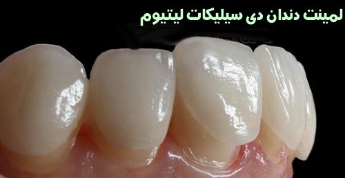 لمینت دندان دی سیلیکات لیتیوم چیست 